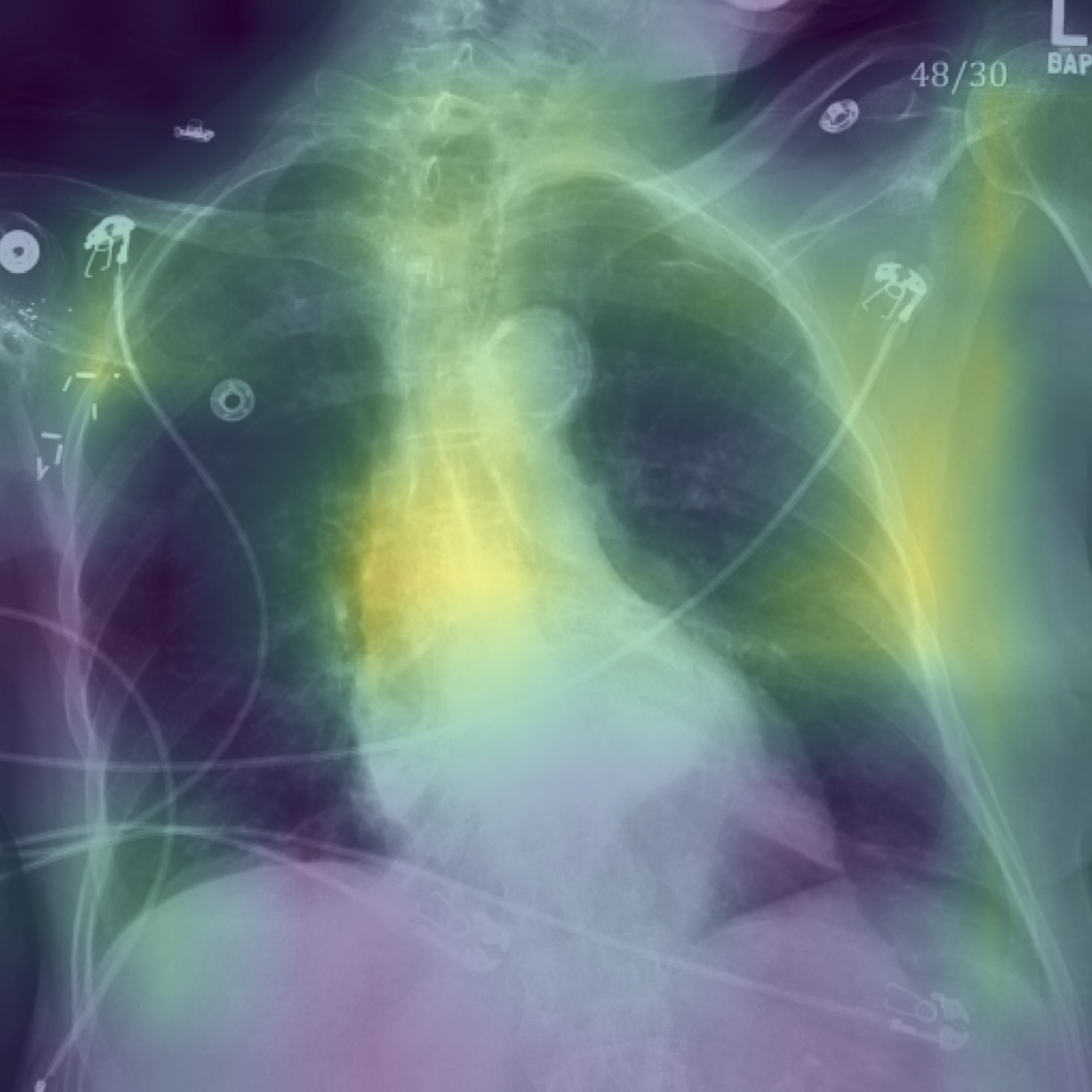 The collar bones, chest bones, and vertebrae of a patient stand out in light purple, and are highlighted in yellow and green. These highlighted areas marked an important diagnostic feature of age in the team's AI model that was trained to predict age but presented as a predictor of pneumonia to the clinicians.