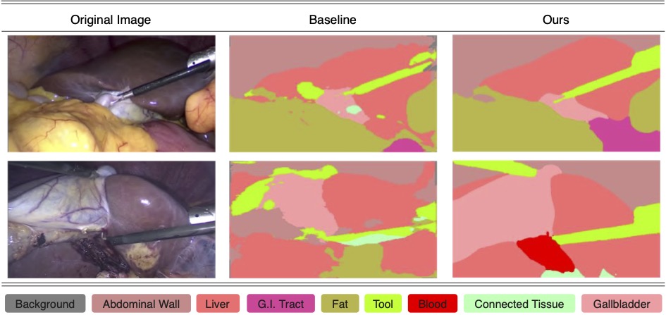 Three columns of images labeled original image, baseline, and ours. Original image: A gallbladder surgery image with a tool placed next to the organ. Baseline: Polygons rendered by UNet color-coded for liver, G.I. Tract, Fat, Tool, Blood, Connected Tissue, and Gallbladder. Ours: Polygons rendered by SegGPT+SAM with the same labels, but more accurately matching the original image